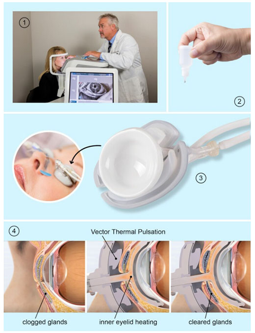 dry eye lipiflow steps