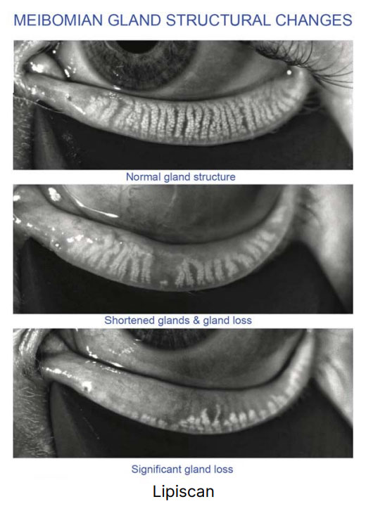 dry eye lipiscan results